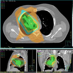 3D imaging for a patient with a lung tumor