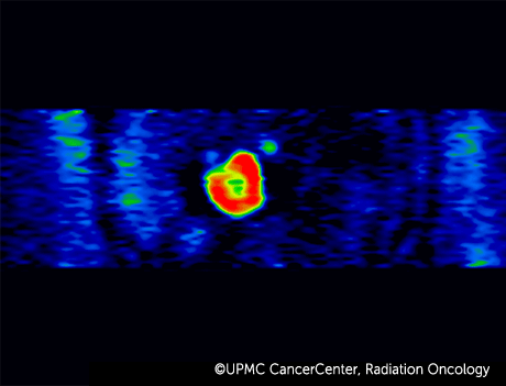 4D PET-CT imaging showing a tumor