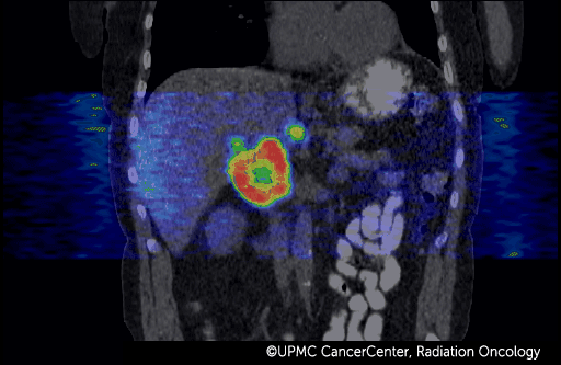 Necrotic tumor shown through 4D PET-CT imaging