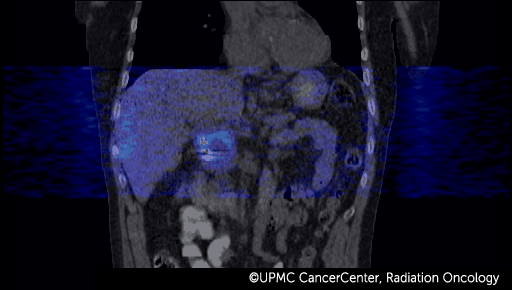 4D PET-CT of the same patient, post-treatment. The tumor has been completely destroyed.
