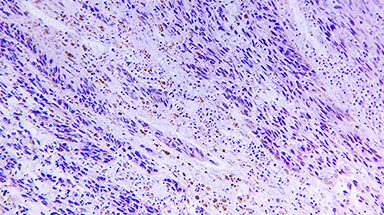 melanoma cells