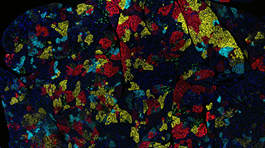 pancreatic cancer cells