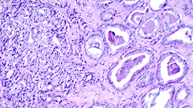 prostate cancer cell