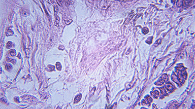 Breast Cancer Cells Image