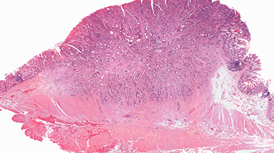 Colorectal Cancer Cells Image