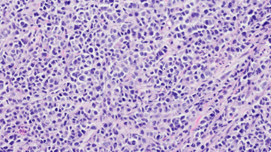 esophageal cancer cell