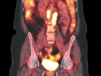 PET-CT scan taken of a patient prior to treatment