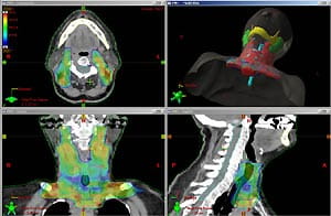 IMRT parotid sparing