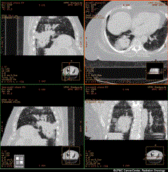 Image generated from lung 4D CT