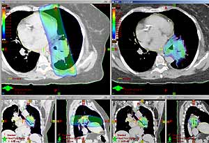 3D conformal radiation therapy images