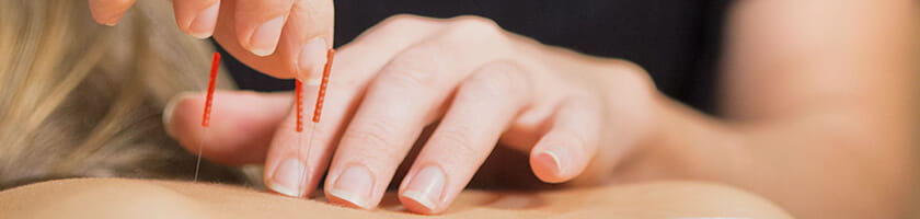 Image of Acupuncture 