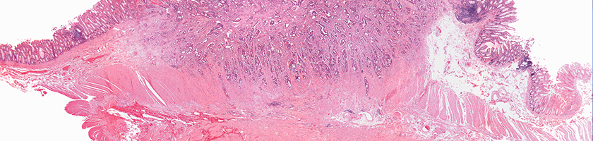 3_4_1 coloretcal_GI_cancer