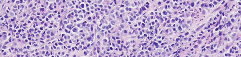 3_6 esophageal_cancer