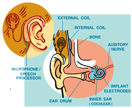 Cochlear Implants