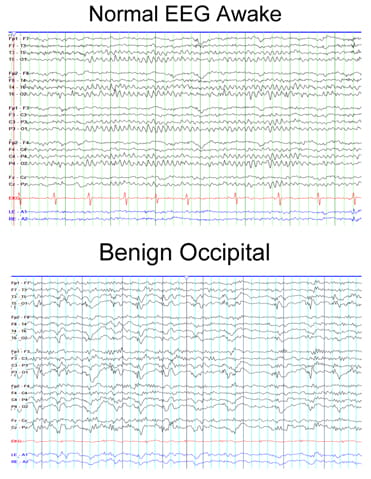 Normal EEG Awake compared to Benign Occipital