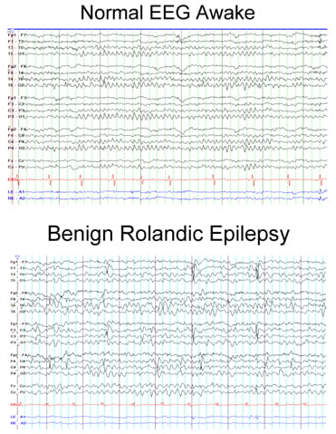 Normal EEG Awake compared to Benign Rolandic Epilepsy