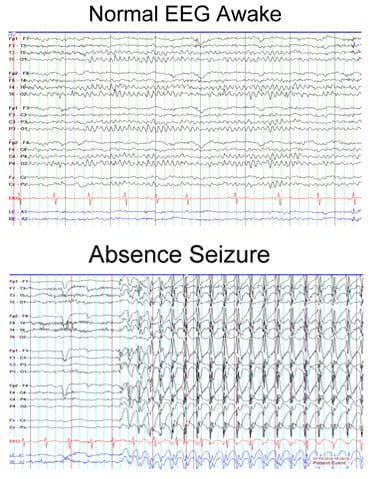 Normal EEG Awake compared to Absence Seizure