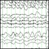 Complex-partial seizures