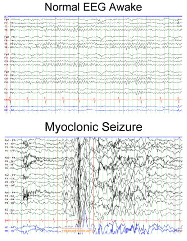 Normal EEG Awake compared to Myoclonic Seizures.
