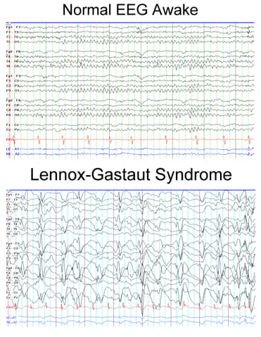 Normal EEG Awake compared to Lennox-Gastaut Syndrome