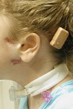 Bone-Anchored Hearing Appliance  in child with congenital aural atresia
