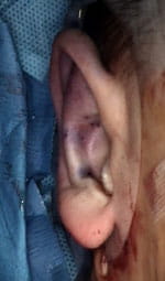 Same child following  surgery to correct prominent ear