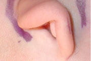 Child with grade 2 microtia (small folded ear)
