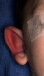 Child with prominent ear