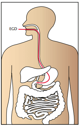 Endoscopy EGD