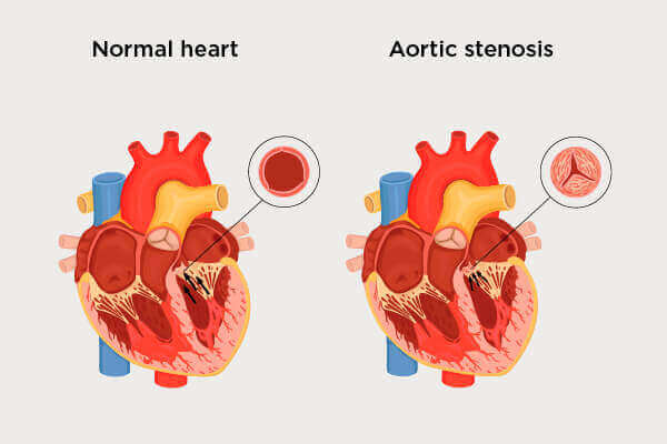 Aortic Stenosis