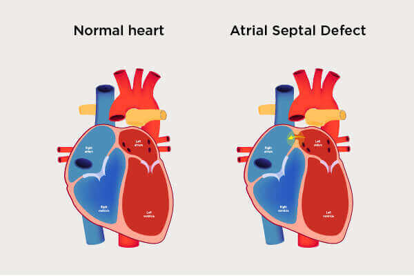 Atrial Septal Defect ASD Interventional Cardiology Program