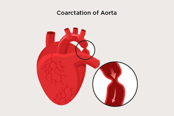 Coarctation of Aorta
