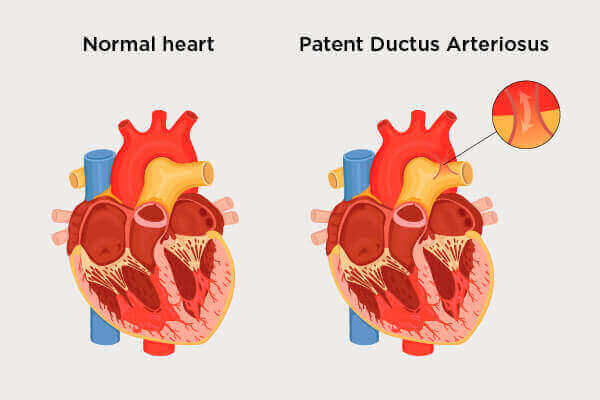 Heart patent clearance