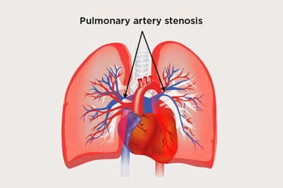 Pulmonary Artery Stenosis
