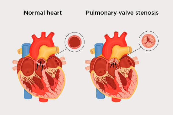 Pulmonary Valve Stenosis