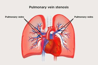 Pulmonary Vein Stenosis