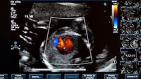 Diagnosing Pediatric Heart Failure