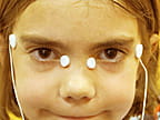 electroretinogram patch placement on a small child