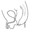 ARM with recto-perineal fistula