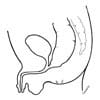 ARM with recto-urinary fistula
