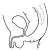 ARM without fistula