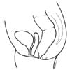 ARM with recto-perineal fistula
