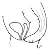 ARM with recto-vestibular fistula