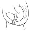 ARM without fistula