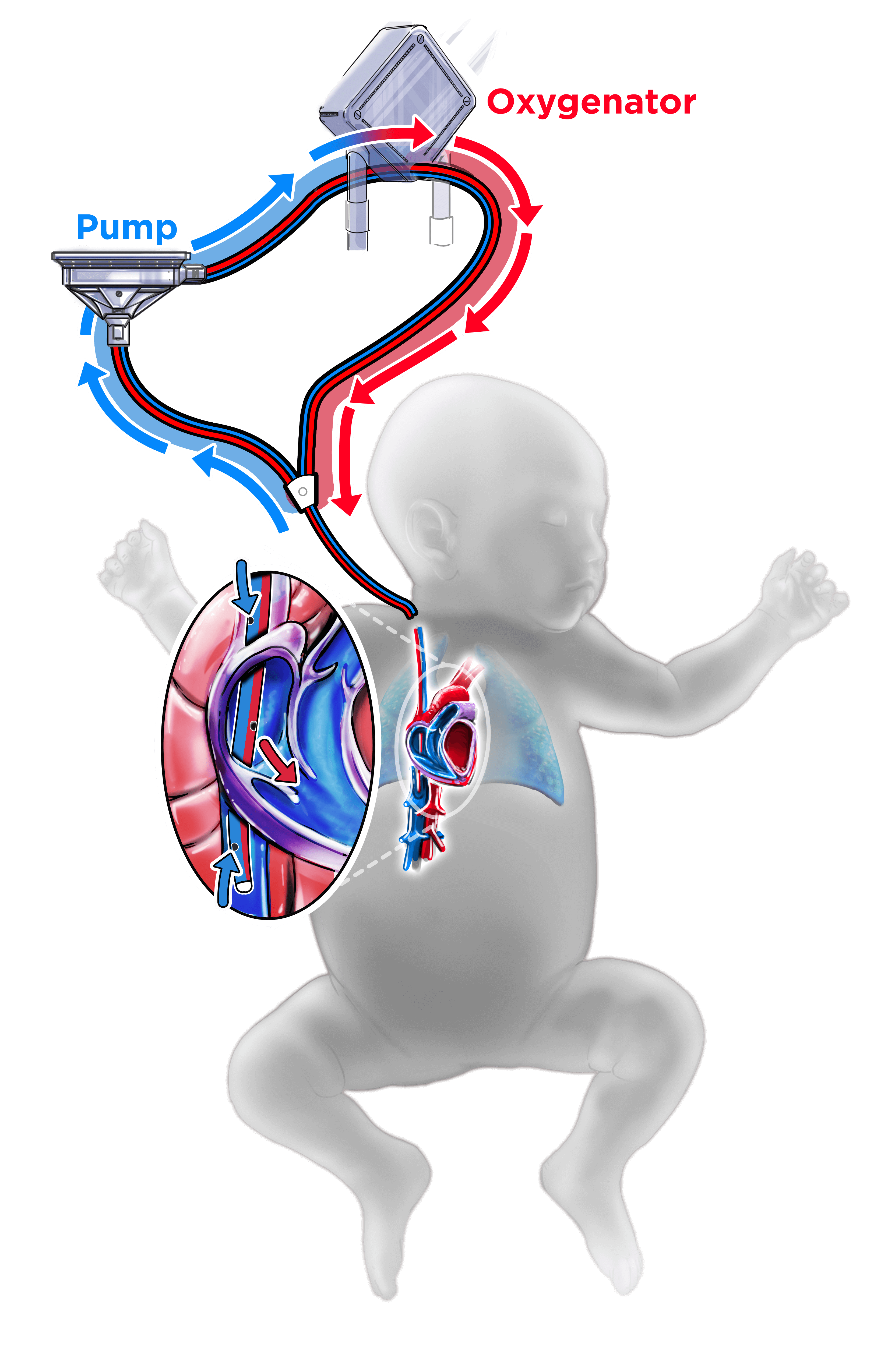 Congenital Diaphragmatic Hernia ECMO