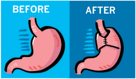 Gastroesophageal Reflux Repair or Wrap Surgery