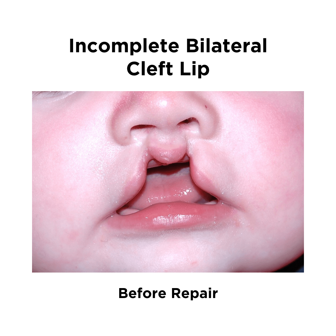 Incomplete Bilateral Cleft Lip