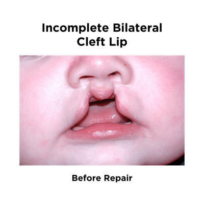 Incomplete Bilateral Cleft Lip