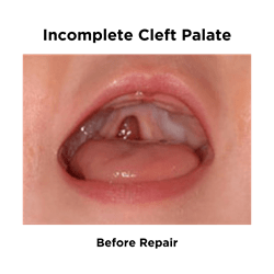 Incomplete Cleft Palate