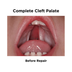 Complete Cleft Palate